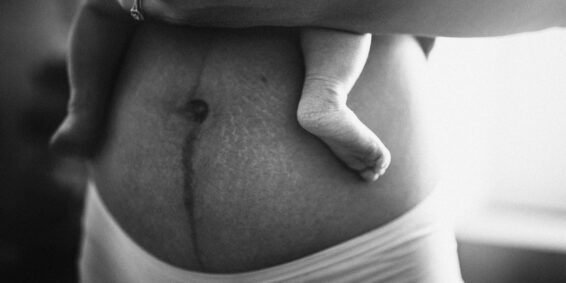 surrogate postpartum with stretch marks and scars on her beautiful belly, holding a newborn baby